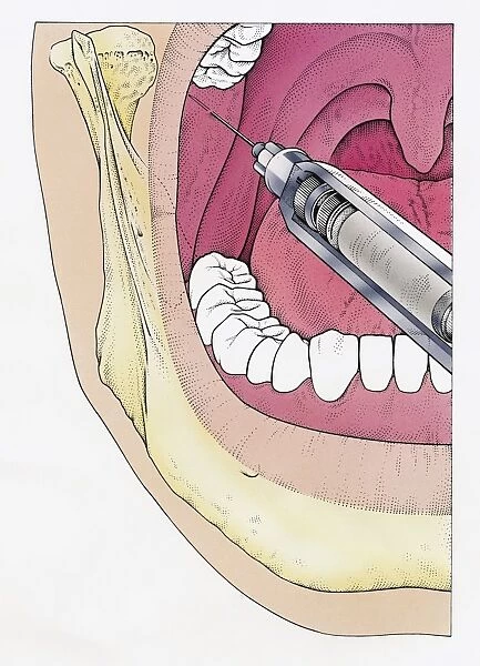 Illustration of injecting open human mouth using syringe seen in cross section showing jaw bone, teeth and epiglottis