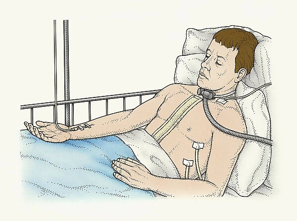 Illustration of male patient lying in bed connected to IV drip, ventilator attached to trachea, and tubes in chest after lung transplant surgery