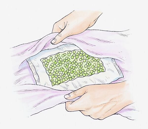 Illustration of a pack of frozen peas being wrapped in a towel to use as a cold compress