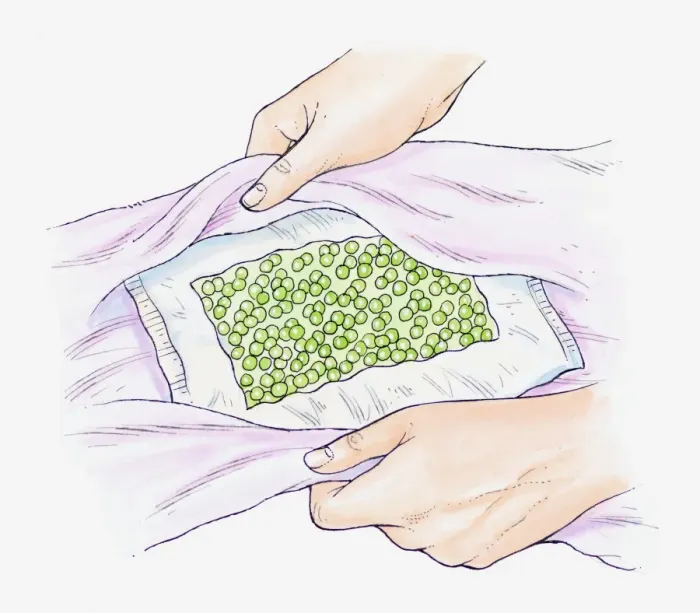 Framed Print : Illustration of a pack of frozen peas being wrapped in a towel to use as a cold compress Framed Print : Illustration of a pack of frozen peas being wrapped in a towel to use as a cold compress
