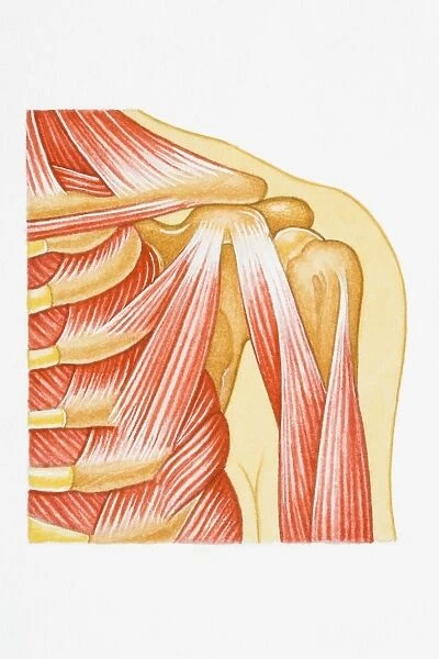 Illustration of separated shoulder, also known as a sprain, with circle around glenohumeral ligament