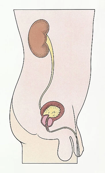 Illustration of showing benign enlargement of the prostate