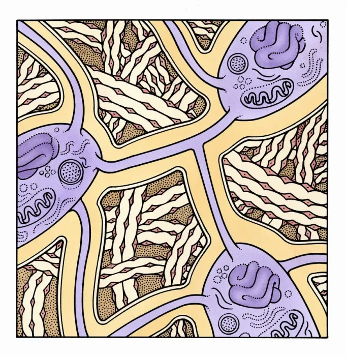 Framed Print : Illustration showing Osteoporosis in human bone Framed Print : Illustration showing Osteoporosis in human bone