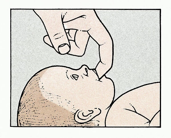 Illustration showing physical examination of babys mouth and palate immediately after birth