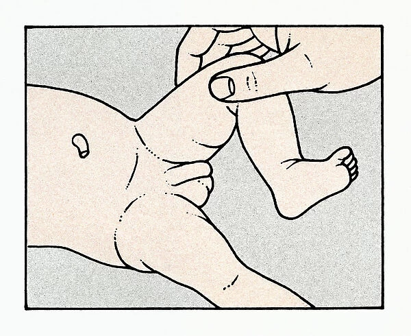 Illustration showing physical examination of babys testis and penis immediately after birth