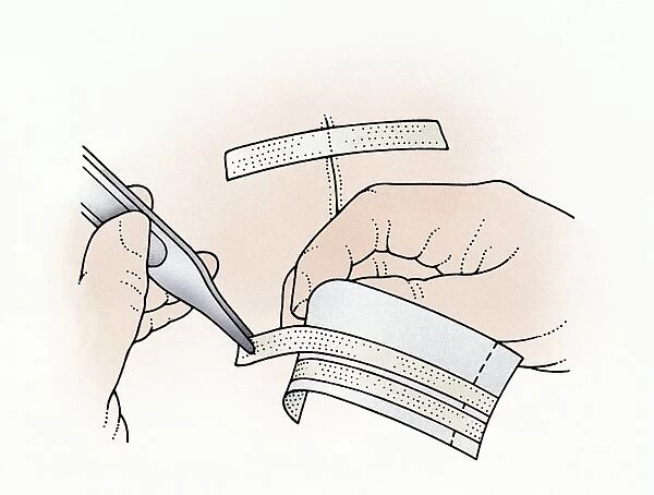 Illustration showing removal of butterfly stitches from adhesive paper using tweezers to apply to wound