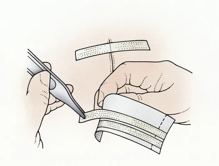 Framed Print : Illustration showing removal of butterfly stitches from adhesive paper using tweezers to apply to wound Framed Print : Illustration showing removal of butterfly stitches from adhesive paper using tweezers to apply to wound