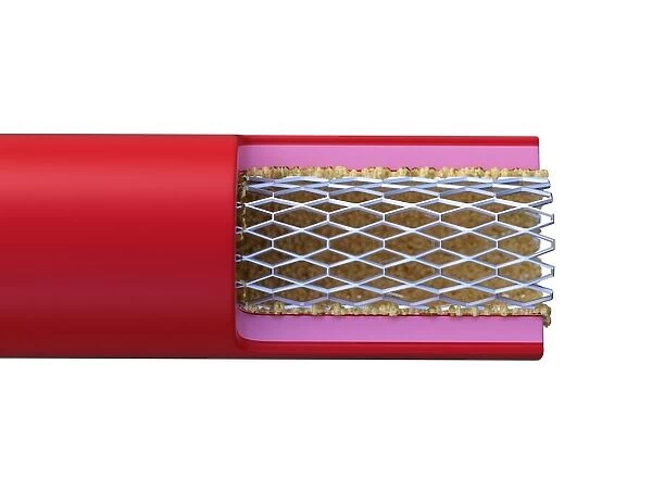 Illustration of stent placed in an artery