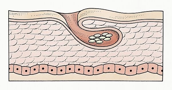 Illustration of subcutaneous scabies eggs
