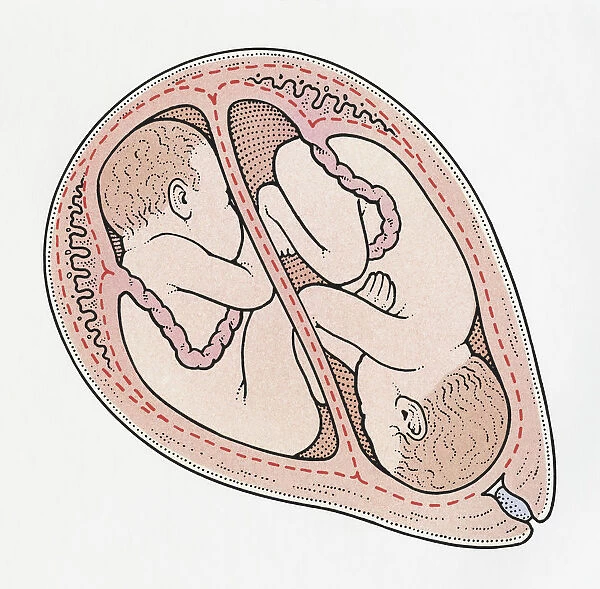Illustration of twin foetuses in cross section of human uterus, one in breech position and the other in normal cephalic position