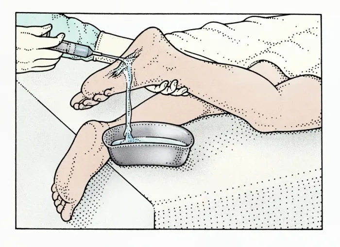 Framed Print : Illustration of using syringe to clean wound on sole of foot Framed Print : Illustration of using syringe to clean wound on sole of foot