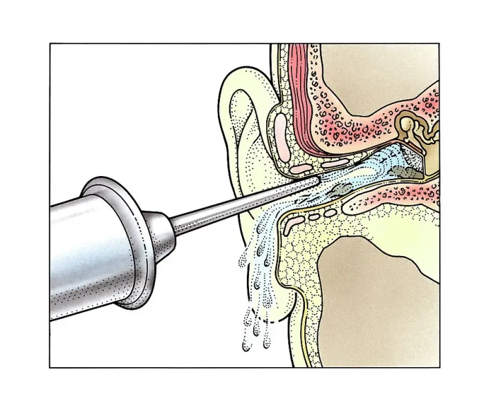 Framed Print : Injecting water into ear with syringe Framed Print : Injecting water into ear with syringe