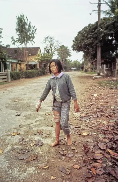 Framed Print : Injured Vietnamese, Hue Framed Print : Injured Vietnamese, Hue