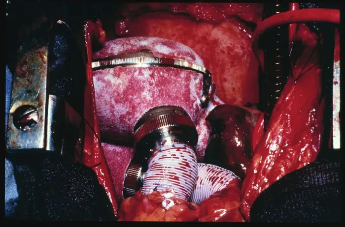 Framed Print : Installing Artificial Heart at Penn State University