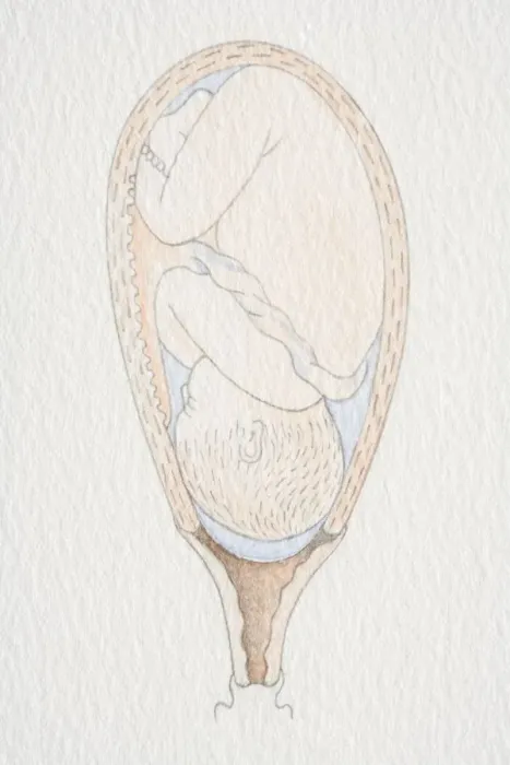 Framed Print : Inverted foetus inside swollen uterus, with amniotic sac still intact and head pushing through the dilated cervix opening