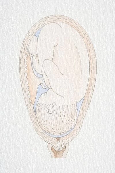 Inverted foetus inside swollen uterus
