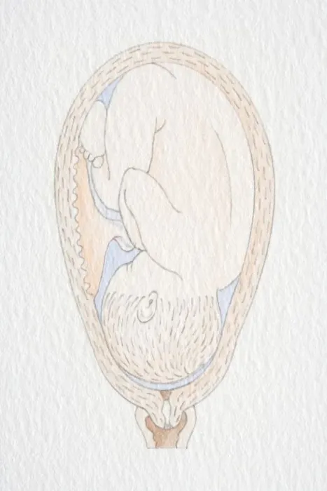 Framed Print : Inverted foetus inside swollen uterus Framed Print : Inverted foetus inside swollen uterus