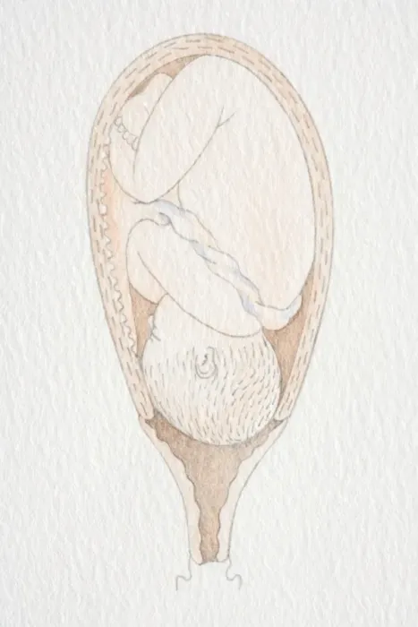 Framed Print : Inverted foetus inside swollen uterus with head pushing through the dilated cervix opening Framed Print : Inverted foetus inside swollen uterus with head pushing through the dilated cervix opening