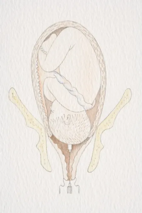 Framed Print : Inverted foetus inside swollen uterus with head pushing through the dilated cervix opening Framed Print : Inverted foetus inside swollen uterus with head pushing through the dilated cervix opening