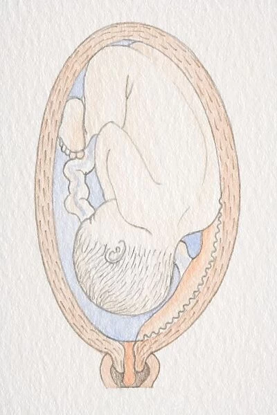 Inverted foetus inside swollen uterus with placenta close to the cervix opening