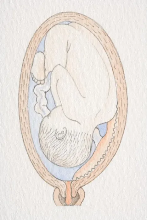 Framed Print : Inverted foetus inside swollen uterus with placenta close to the cervix opening Framed Print : Inverted foetus inside swollen uterus with placenta close to the cervix opening