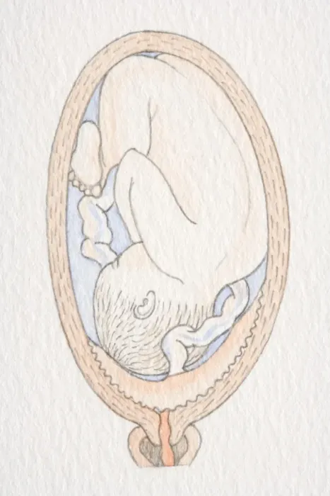 Framed Print : Inverted foetus inside swollen uterus with placenta covering cervix opening