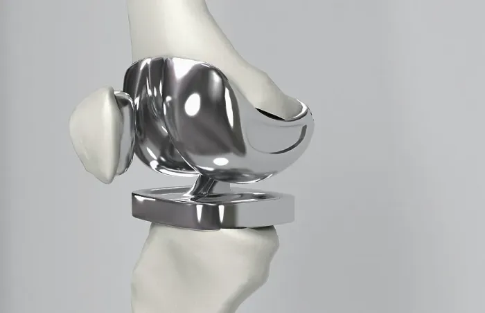 Framed Print : Knee replacement Framed Print : Knee replacement
