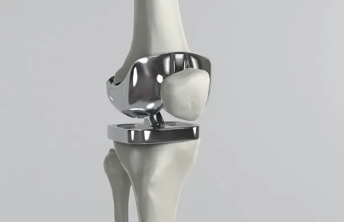 Framed Print : Knee replacement Framed Print : Knee replacement