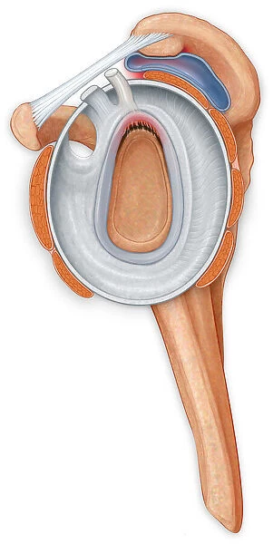 Lateral view of the shoulder joint showing a tear in the labrum and an inflammed bursa