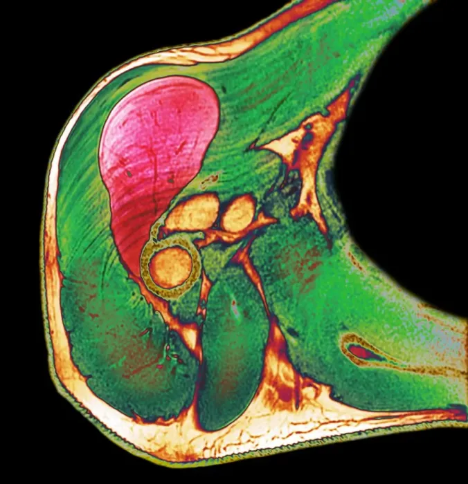 Framed Print : Lipoma of the shoulder, X-ray Framed Print : Lipoma of the shoulder, X-ray