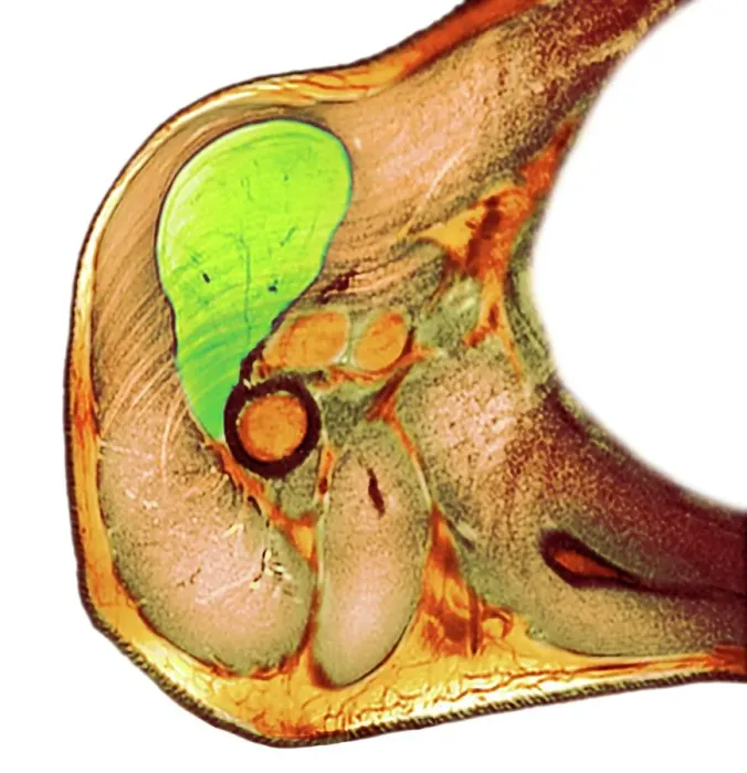 Framed Print : Lipoma of the shoulder, X-ray Framed Print : Lipoma of the shoulder, X-ray