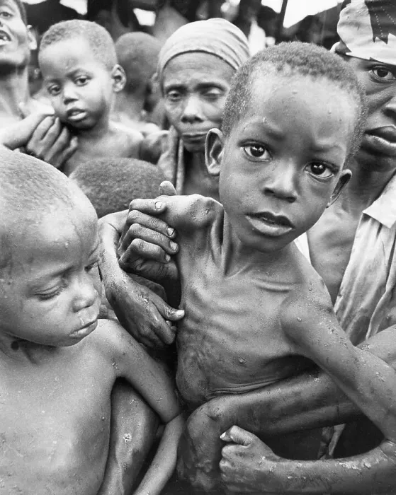 Framed Print : Malnourished Nigerian Child Framed Print : Malnourished Nigerian Child