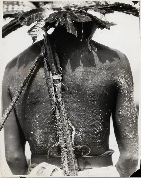 Framed Print : Man From San Blas W / Scarring On Back Framed Print : Man From San Blas W / Scarring On Back