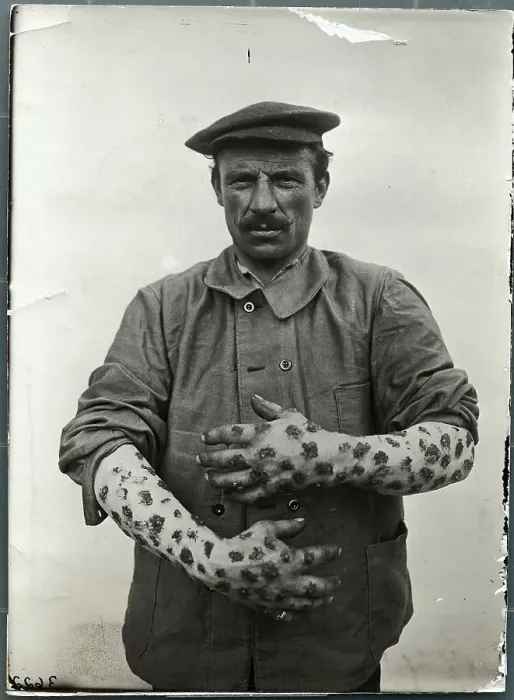 Framed Print : Man with Sores on Arms and Hands Framed Print : Man with Sores on Arms and Hands