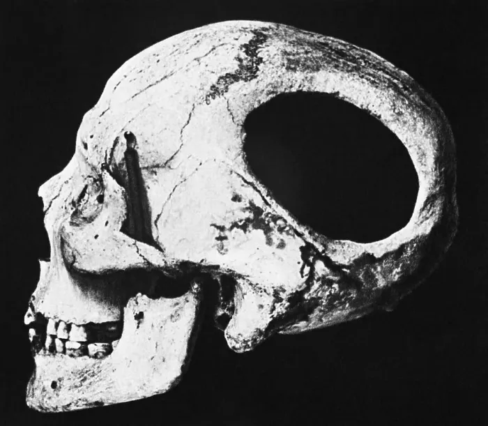 Framed Print : Neolithic Skull with Hole Framed Print : Neolithic Skull with Hole