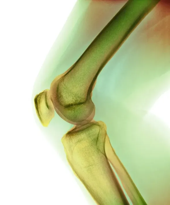 Framed Print : Normal knee, X-ray Framed Print : Normal knee, X-ray