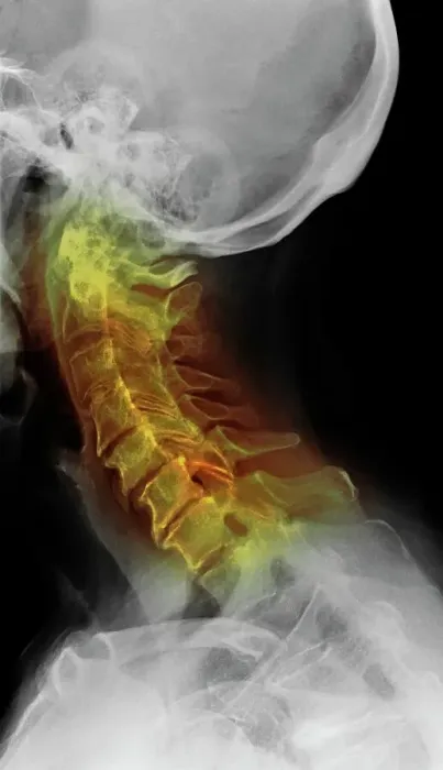 Framed Print : Osteoarthritis of the cervical spine, X-ray Framed Print : Osteoarthritis of the cervical spine, X-ray