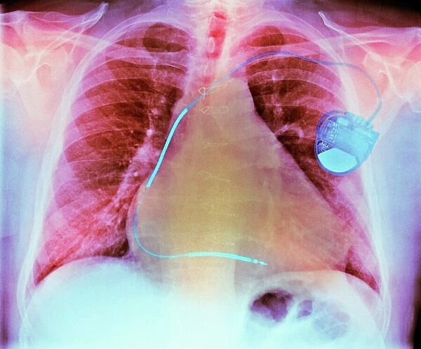 Pacemaker in heart disease, X-ray