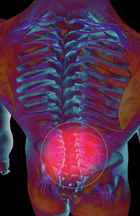 Framed Print : Back pain. A posterior view of a male torso revealing the skeletal Framed Print : Back pain. A posterior view of a male torso revealing the skeletal