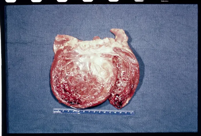 Framed Print : Photo of Cobbs diseased heart Framed Print : Photo of Cobbs diseased heart