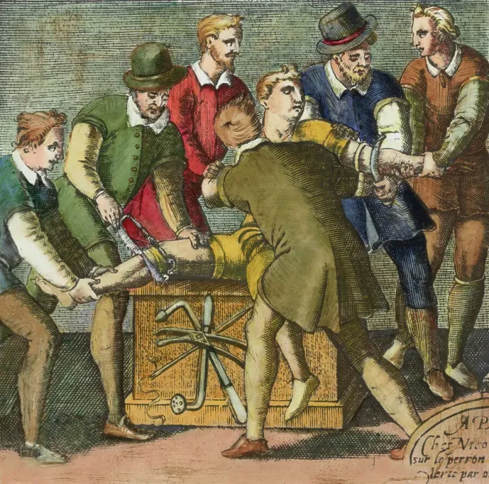 Framed Print : Physician and Assistants during Early History Leg Amputation Framed Print : Physician and Assistants during Early History Leg Amputation