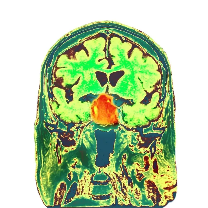 Framed Print : Pituitary tumour, CT scan Framed Print : Pituitary tumour, CT scan