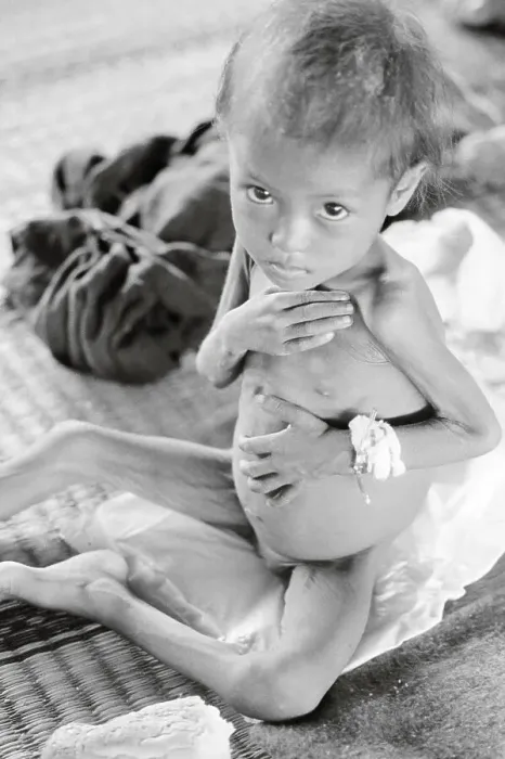 Framed Print : Portrait of an Emaciated Cambodian Child Framed Print : Portrait of an Emaciated Cambodian Child