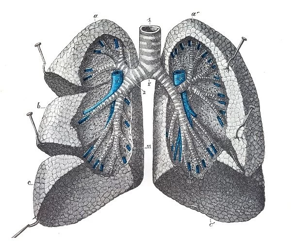 Pulmonary mass engraving 1899