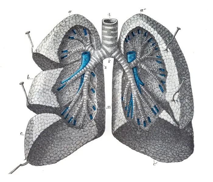 Framed Print : Pulmonary mass engraving 1899 Framed Print : Pulmonary mass engraving 1899