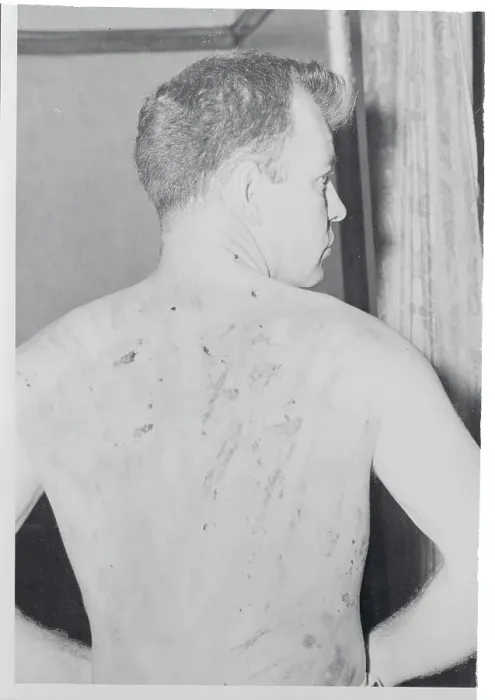 Framed Print : Scarred Back of Suspected Religious Sect Murderer Framed Print : Scarred Back of Suspected Religious Sect Murderer
