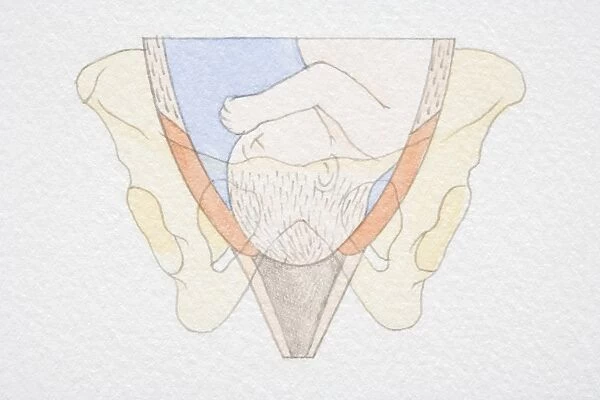 Section diagram of swollen uterus with foetus head pushing through the dilated cervix opening