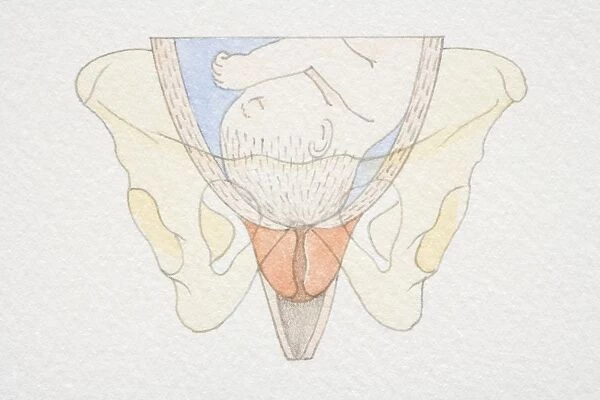 Section diagram of swollen uterus with foetus head pushing down on cervix opening