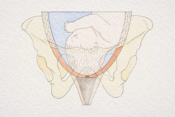 Section diagram of swollen uterus with foetus head pushing down on cervix opening
