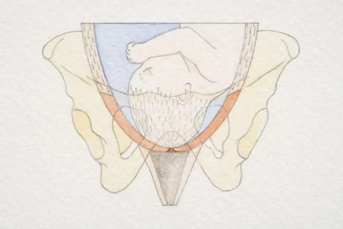 Framed Print : Section diagram of swollen uterus with foetus head pushing down on cervix opening